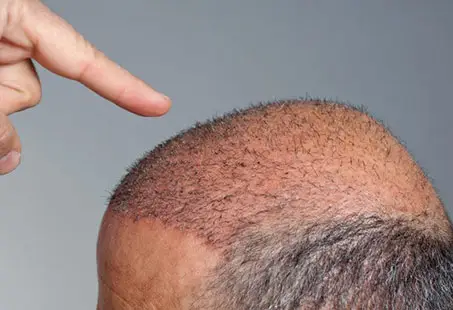 Hair Transplant Scarring