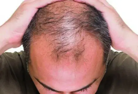 male pattern baldness