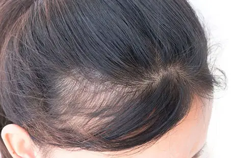 PCOS Hair Loss