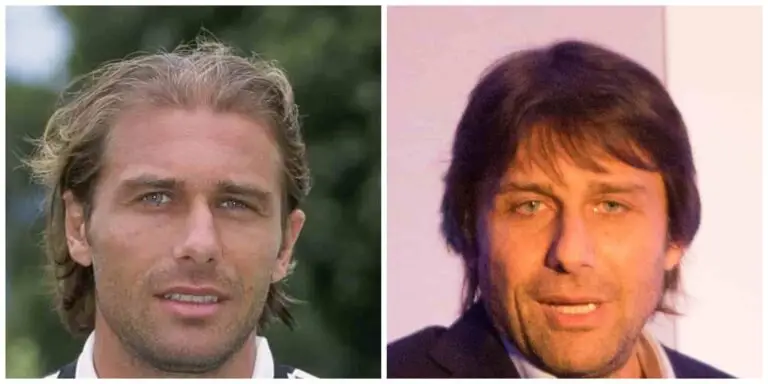 antonio conte hair transplant before and after