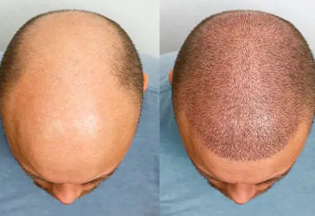 hair transplant