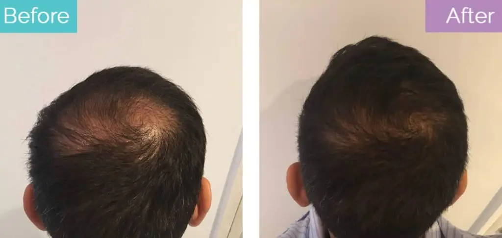 12 months after crown transplant