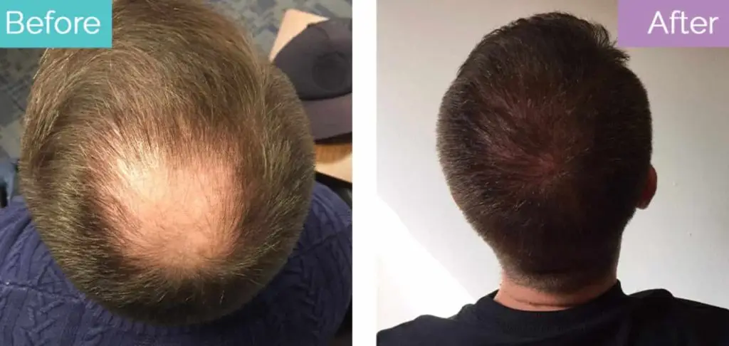 6 months after crown transplant