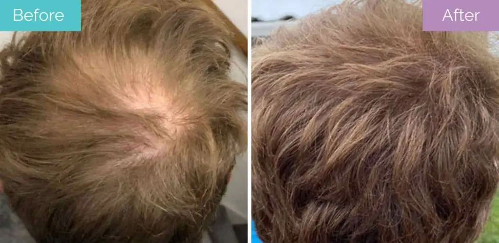 Crown hair transplant