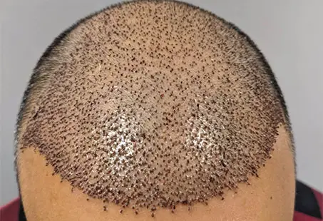 hair transplant scabs