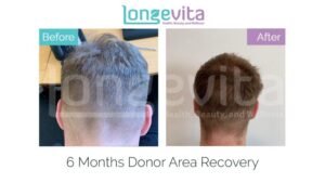 Hair Transplant Donor Area: 6 Tips For Speedy Recovery