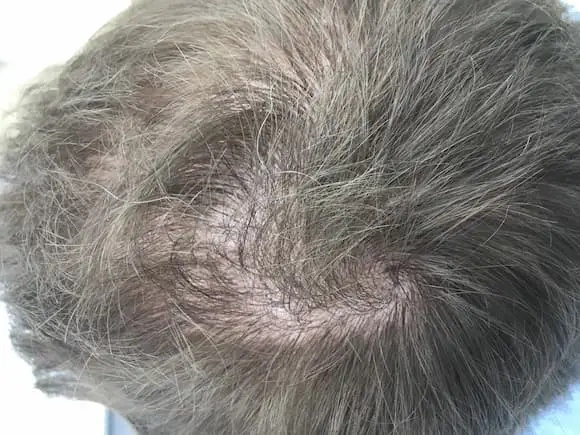 Crown hair transplant