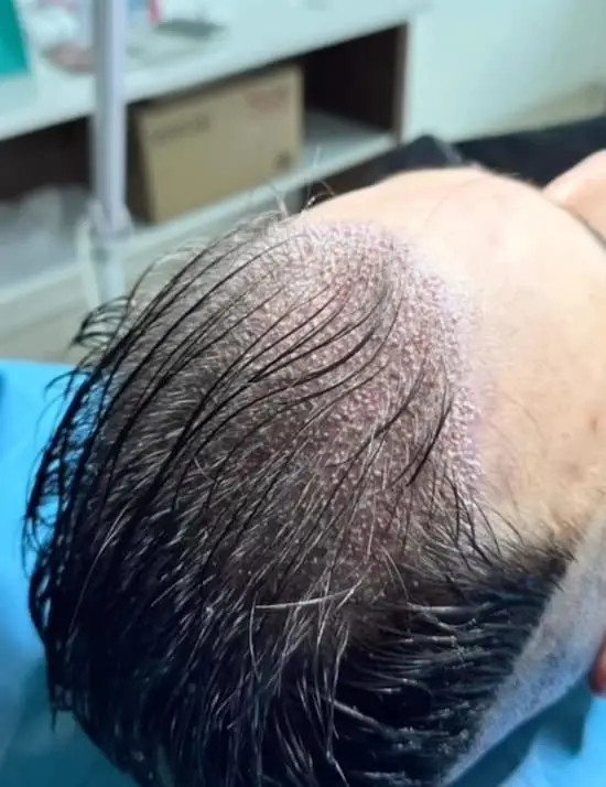 Hair transplant grafts