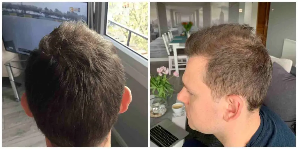 Hair transplant results f