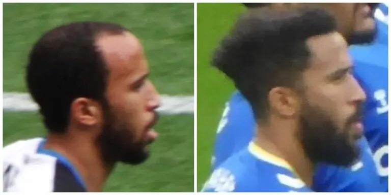 Andros Townsend before and after hair transplant