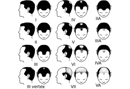 Norwood scale