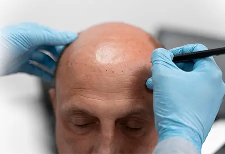 hair transplant side effects