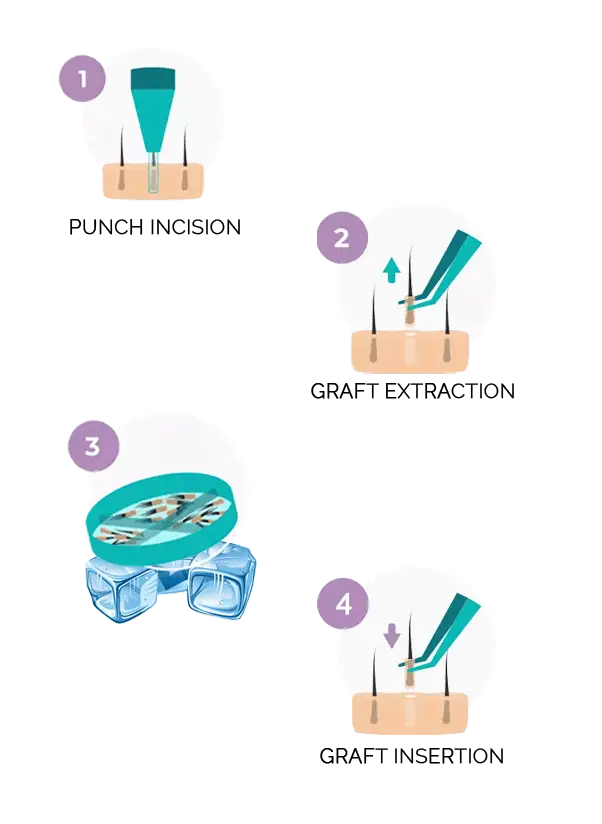 ice graft hair transplant