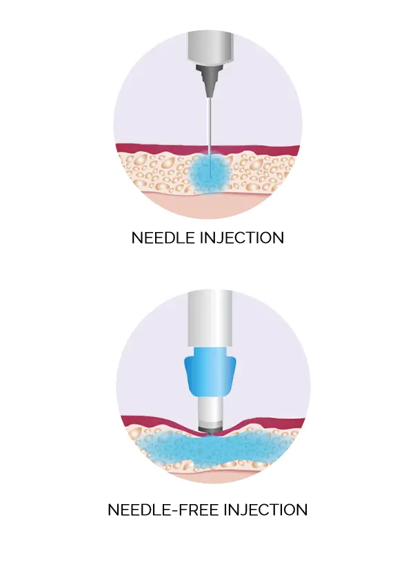 A diagram compares needle and needle-free injections. The top section shows a needle penetrating skin, labeled "NEEDLE INJECTION." Below, a jet injector contacts skin, labeled "NEEDLE-FREE INJECTION."