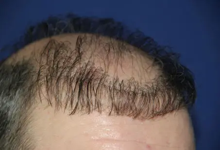 hair transplant goes wrong