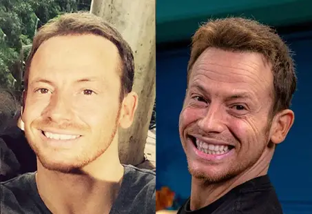 jow swash before and after hair transplant