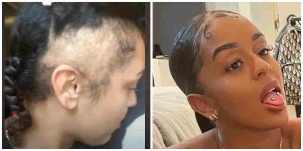 Paigey Cakey before and after hair transplant