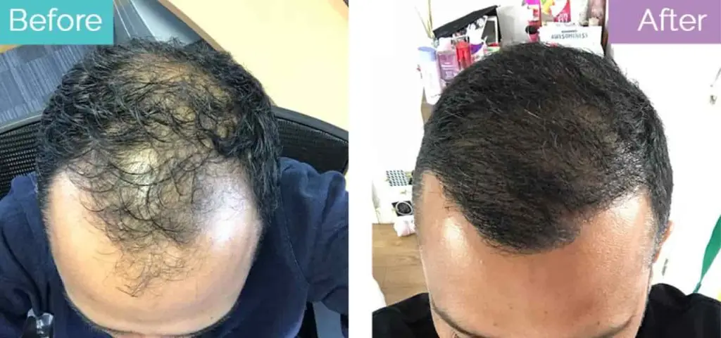 Hair loss treatment