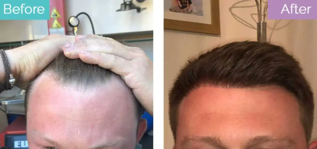 Hair transplant results