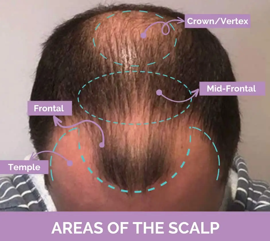 Temple area on scalp