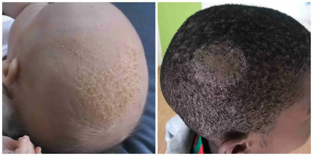 hair loss at young age