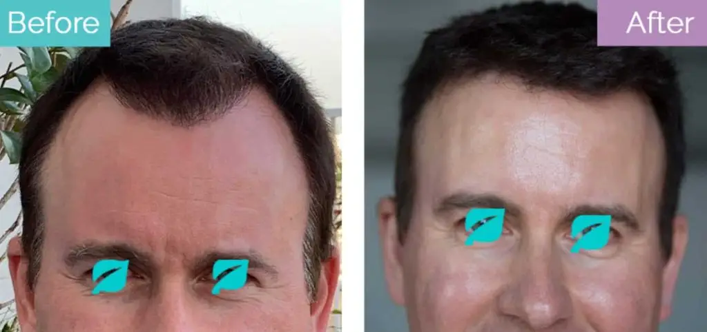 hair transplant to treat hair loss