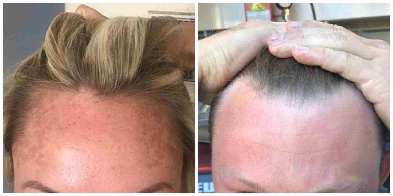 Temple Hair Loss: Why It’s Happening & What You Can Do