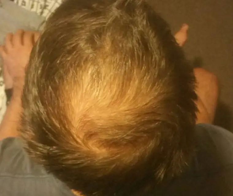 Crown hair loss