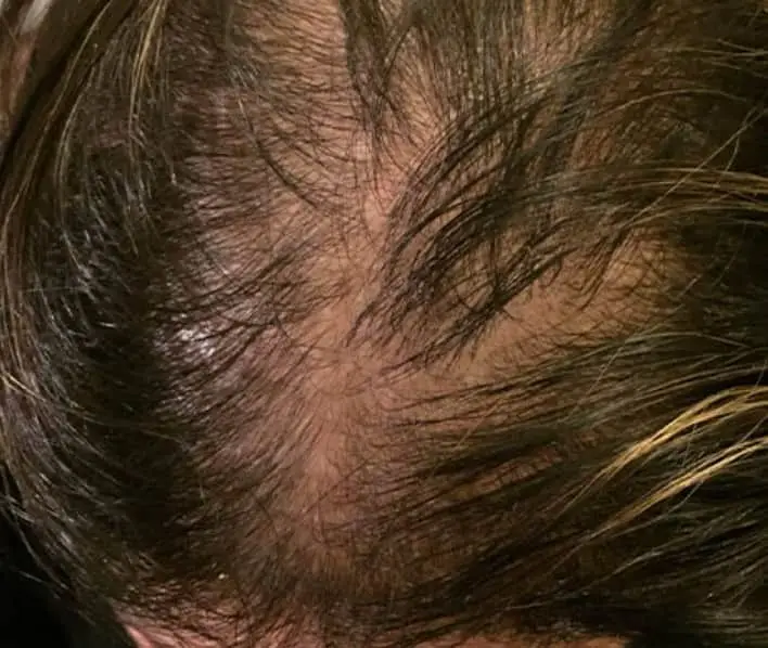 Female pattern baldness