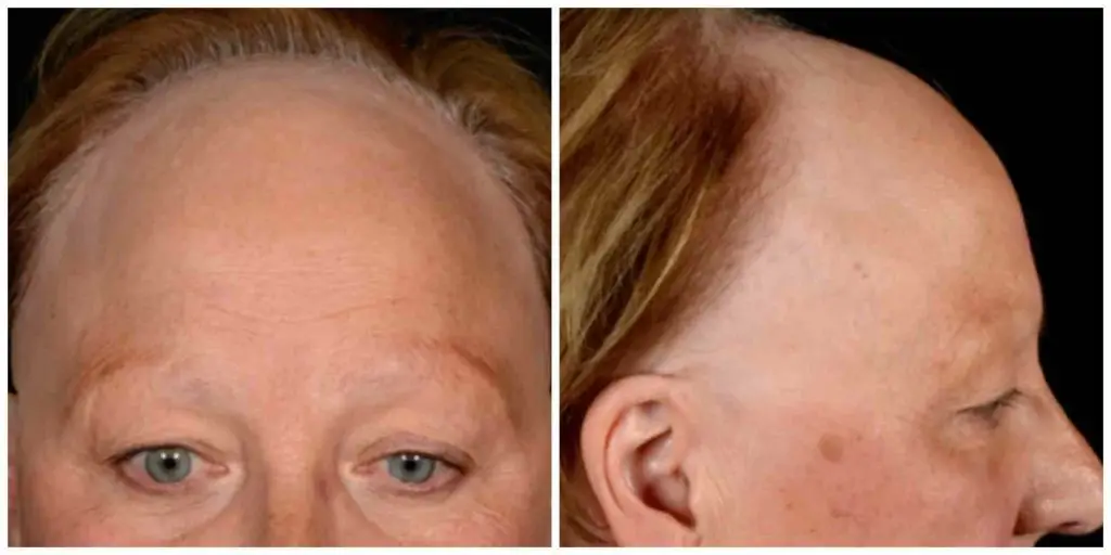 Frontal fibrosing alopecia