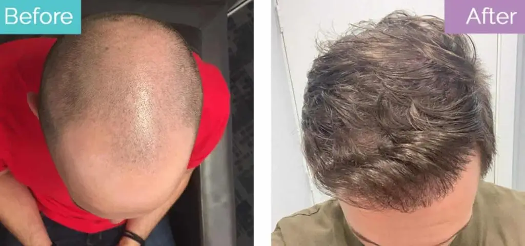 Hair transplant