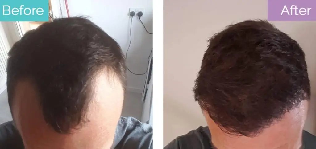 Hair transplant for pattern baldness