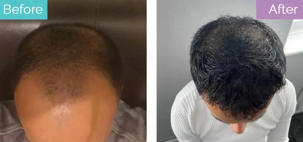 Hair transplant results