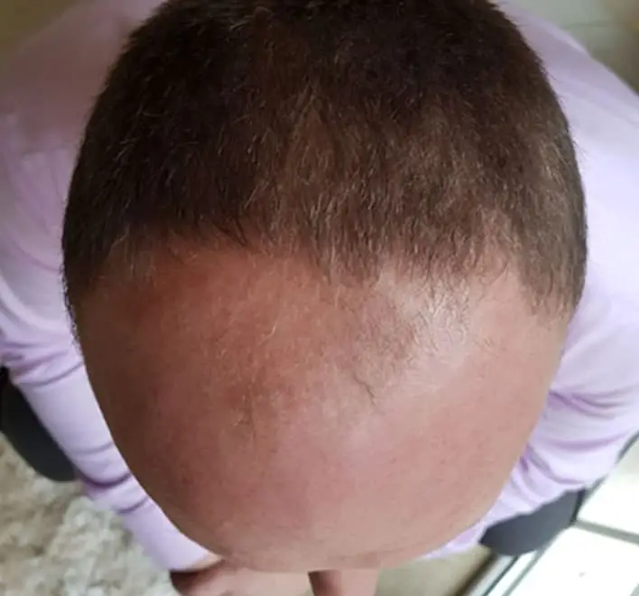 Male pattern hair loss