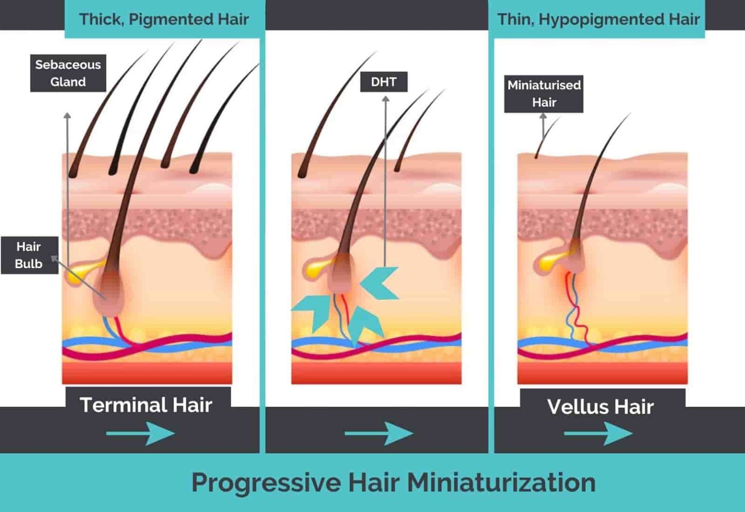 Hair Miniaturization: What Is It & Can You Reverse It?