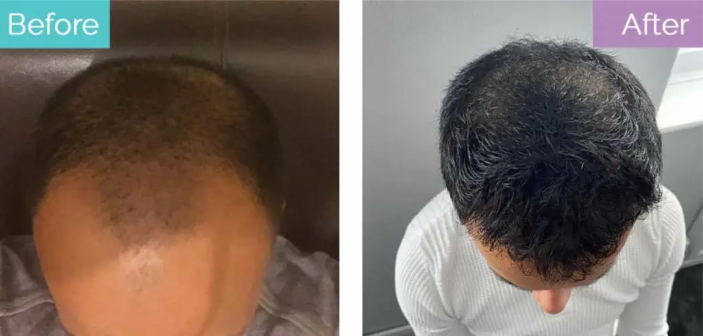 testosterone hair transplant