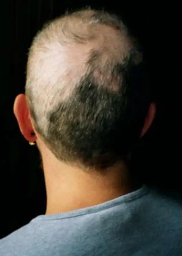 Trichotillomania neck hair loss