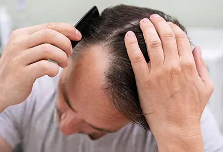 androgenetic alopecia