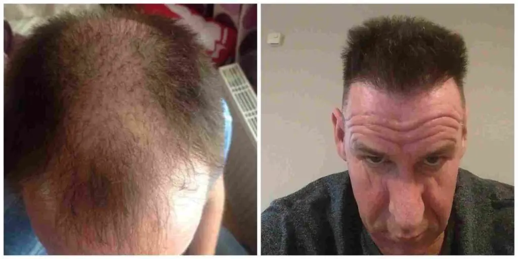 Hair transplant old age