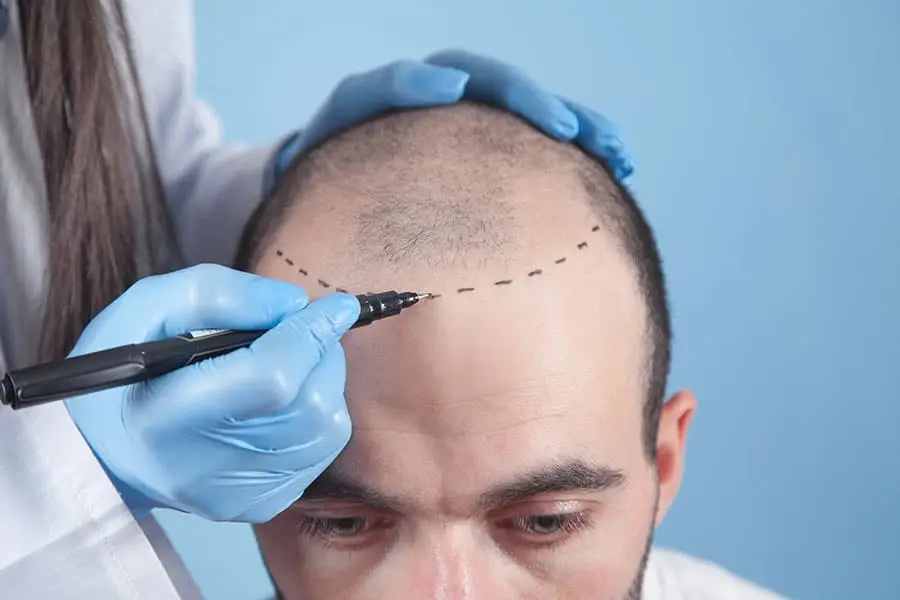 Hair transplant