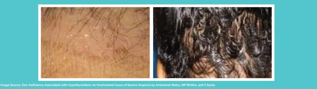 Hyperthyroidism hair loss