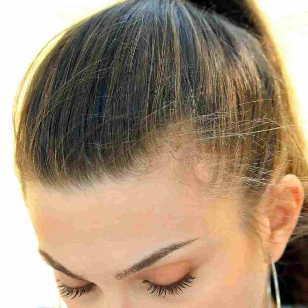 Traction traumatic alopecia