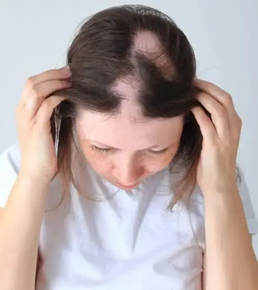 Trichotillomania bald spots