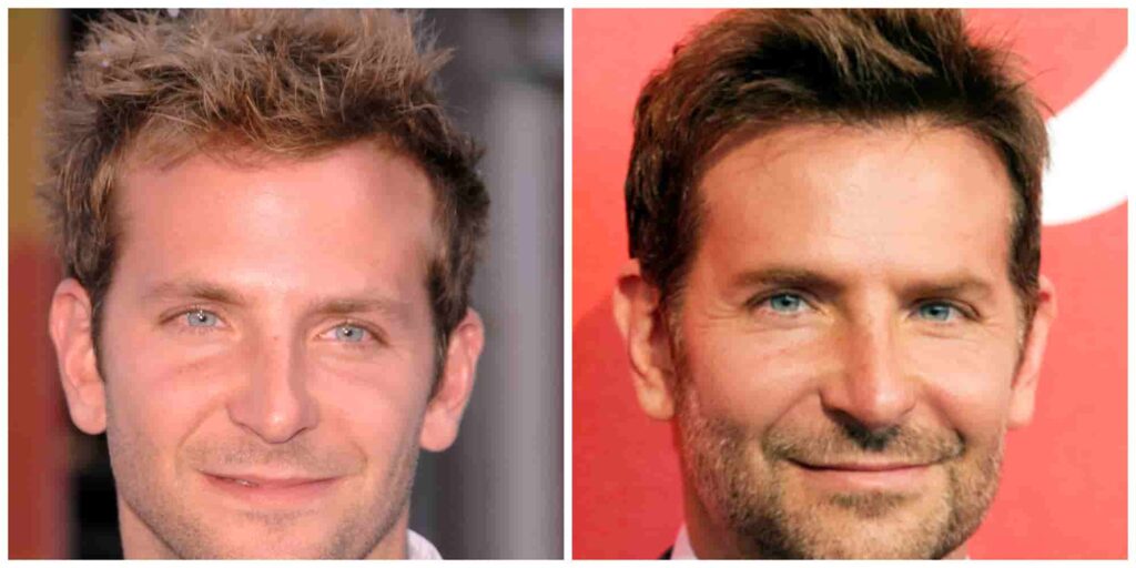 Bradley Cooper before and after hair transplant