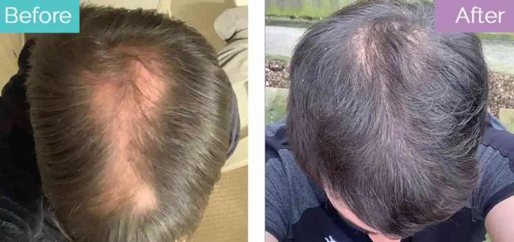 Hair transplant (1)