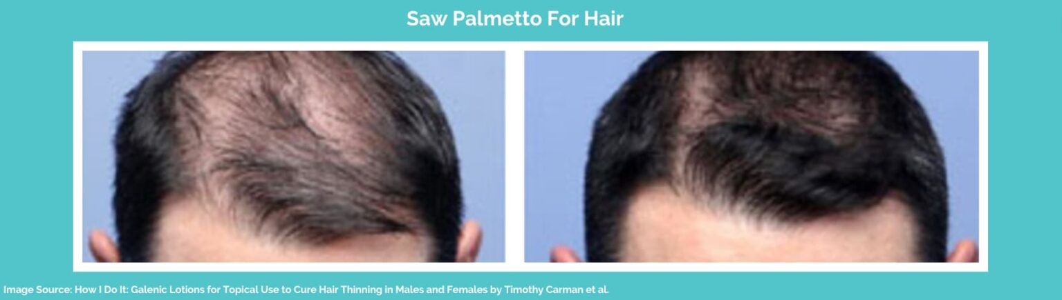 Saw Palmetto For Hair Loss: How It Works & Usage | Longevita