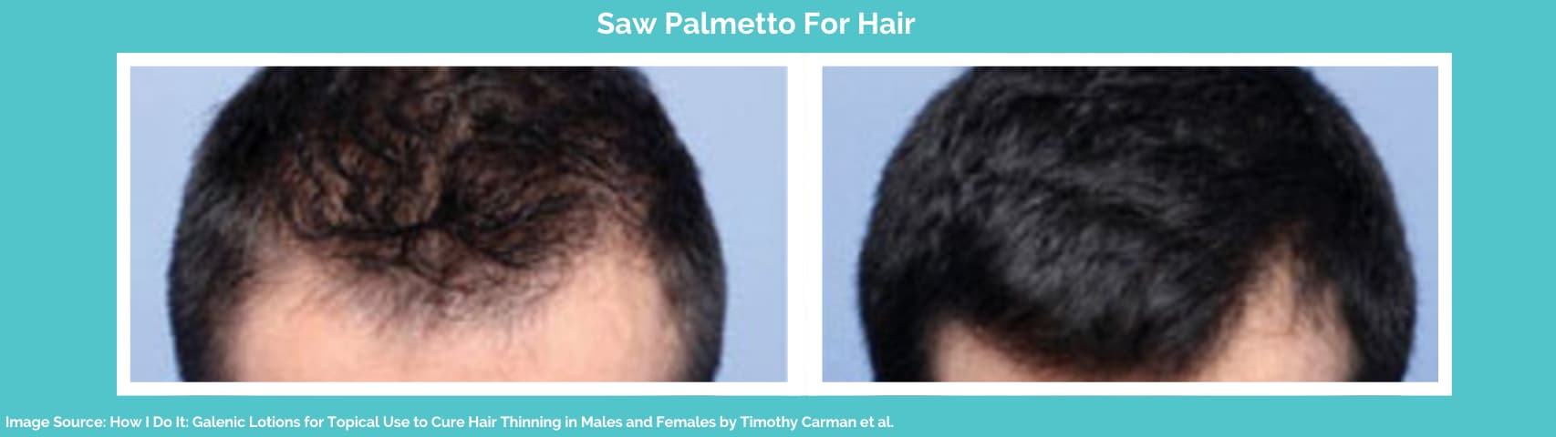 Saw Palmetto For Hair Loss: How It Works & Usage | Longevita