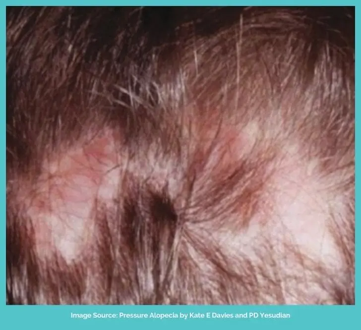 Scarring Pressure Alopecia