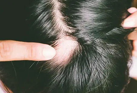 traumatic alopecia