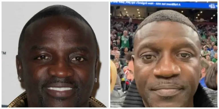 Akon hair transplant before and after